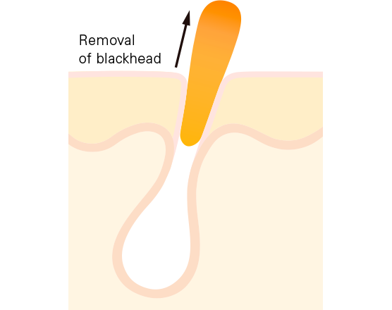 stratum corneum blackhead removal