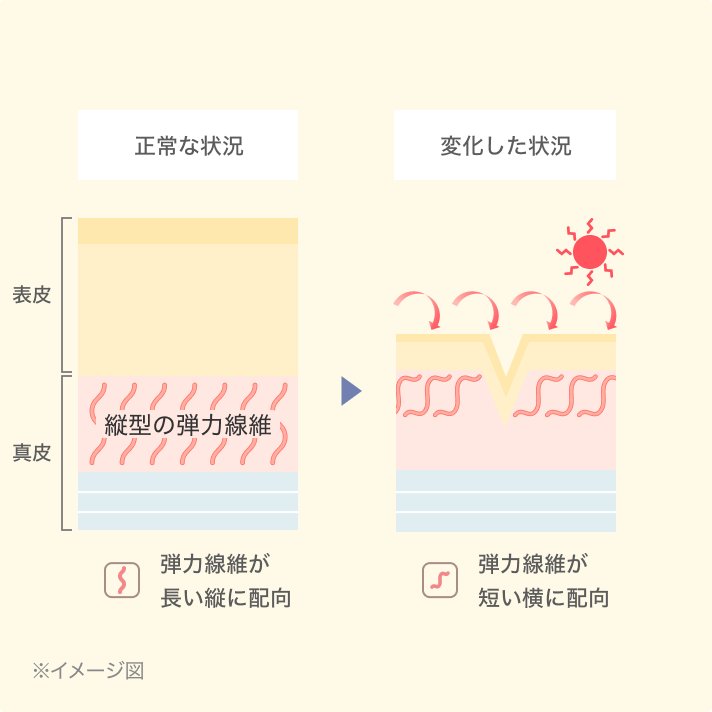 表皮と真皮が正常な状態から、紫外線を受けダメージが蓄積し、縦向きの弾性繊維が短く横向きに変化をした状況の断面イメージ図
