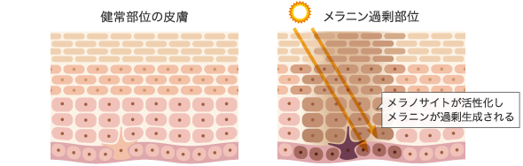 メラニン過剰部位。メラノサイトが活性化しメラニンが過剰生成される。
