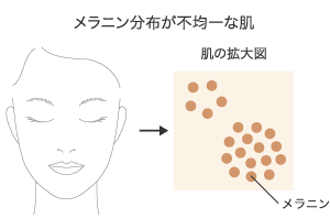 メラニン分布が不均一な肌（イメージ）